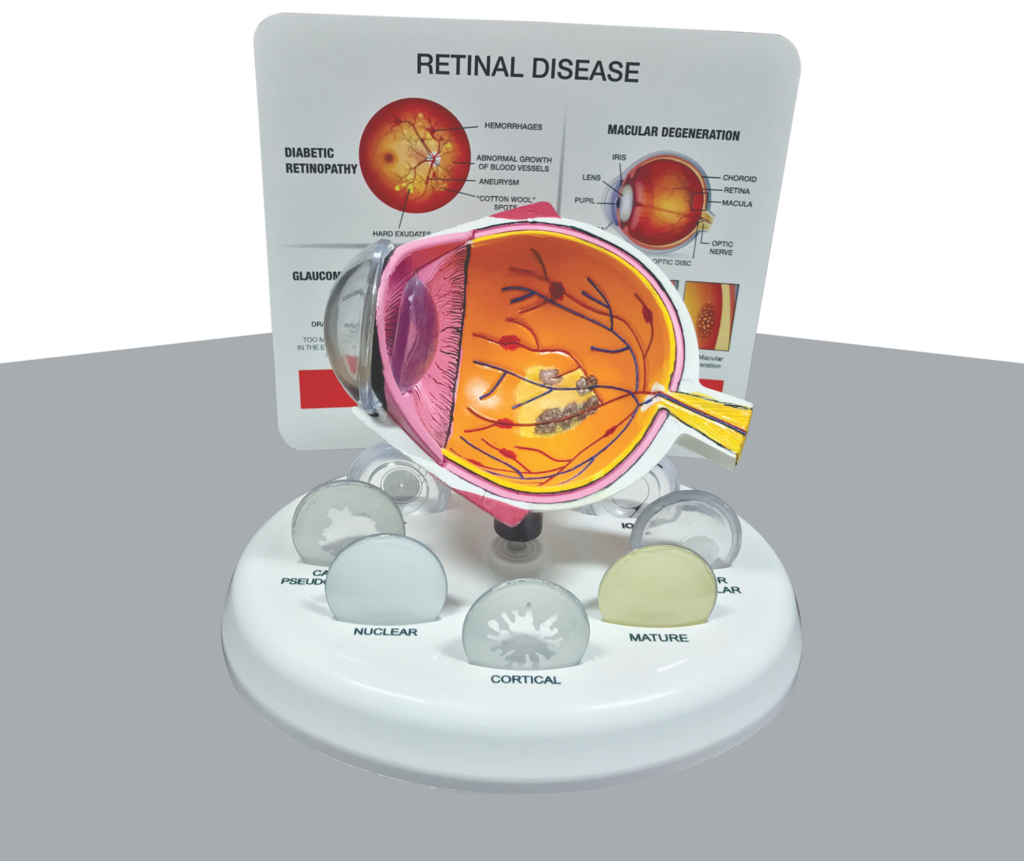 Retinal Disease Eye Model