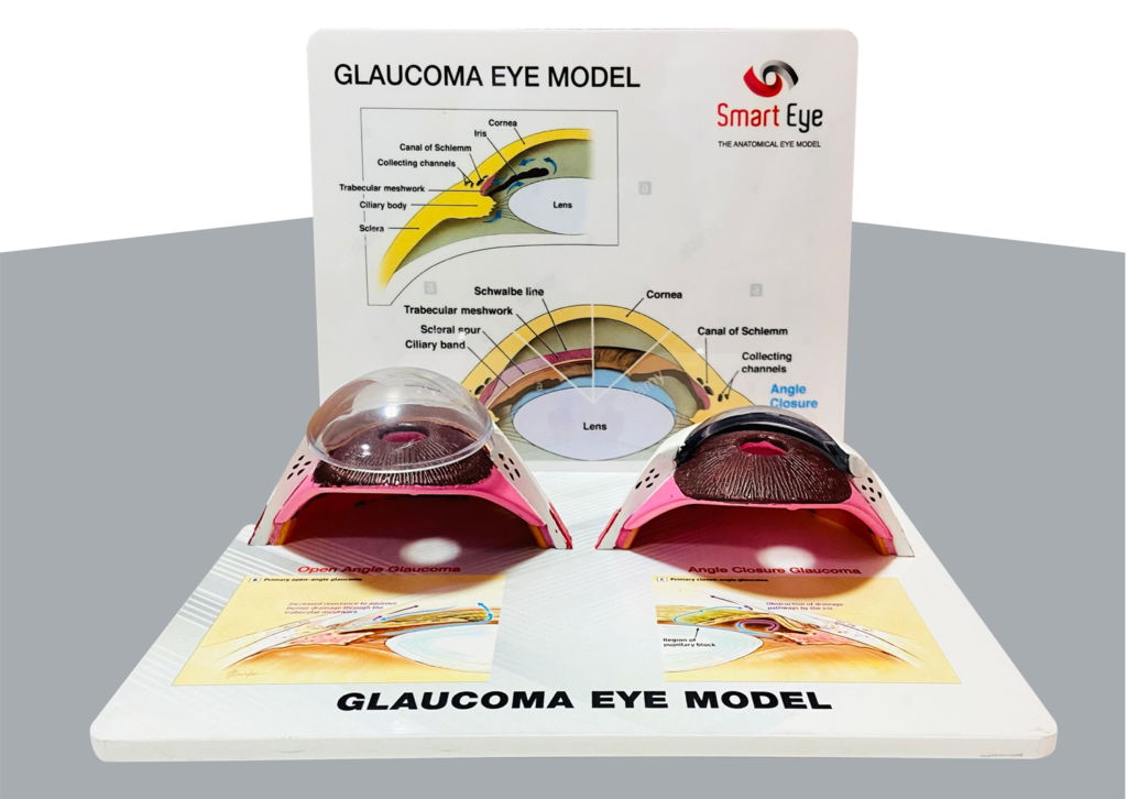 Glaucoma Eye Model
