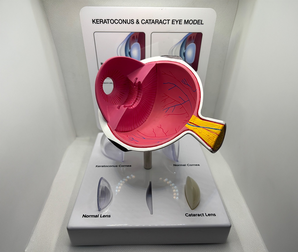 Keratoconus and Cataract Eye Model